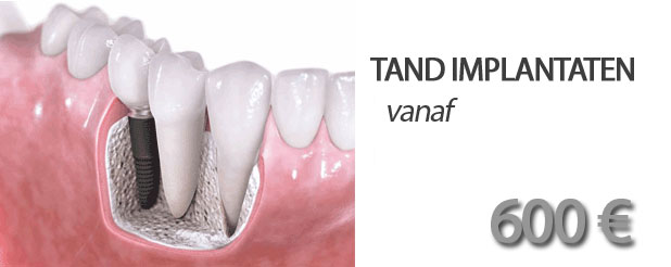 tand implantaten