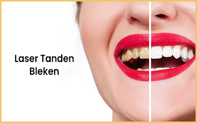 Tandenbleken Turkije